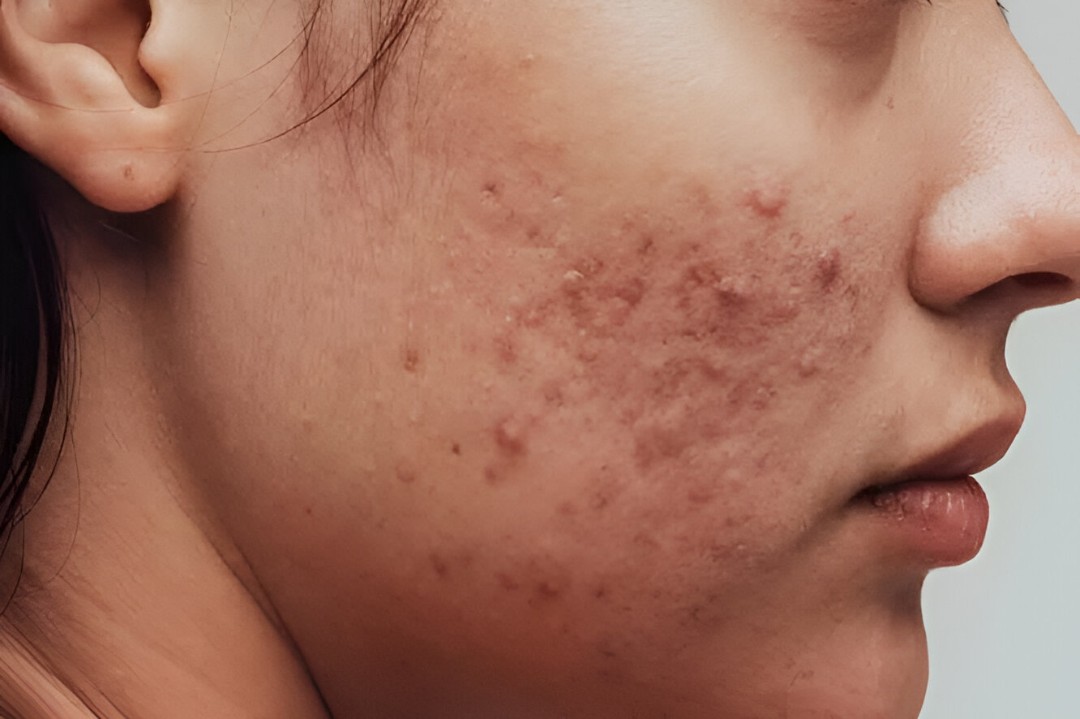 Acne_and_Pigmentation_Treatment
