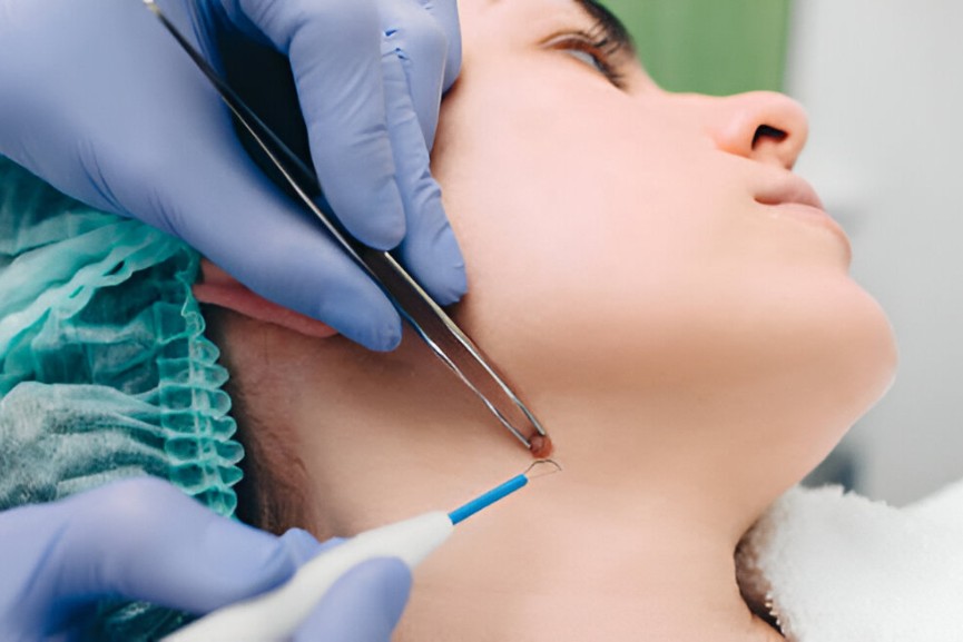 Electro_Cautery_Procedures