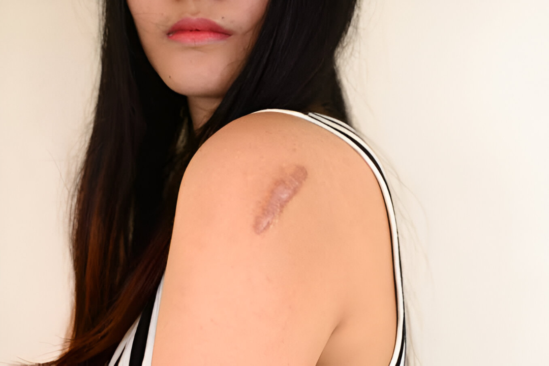 Keloid_treatment