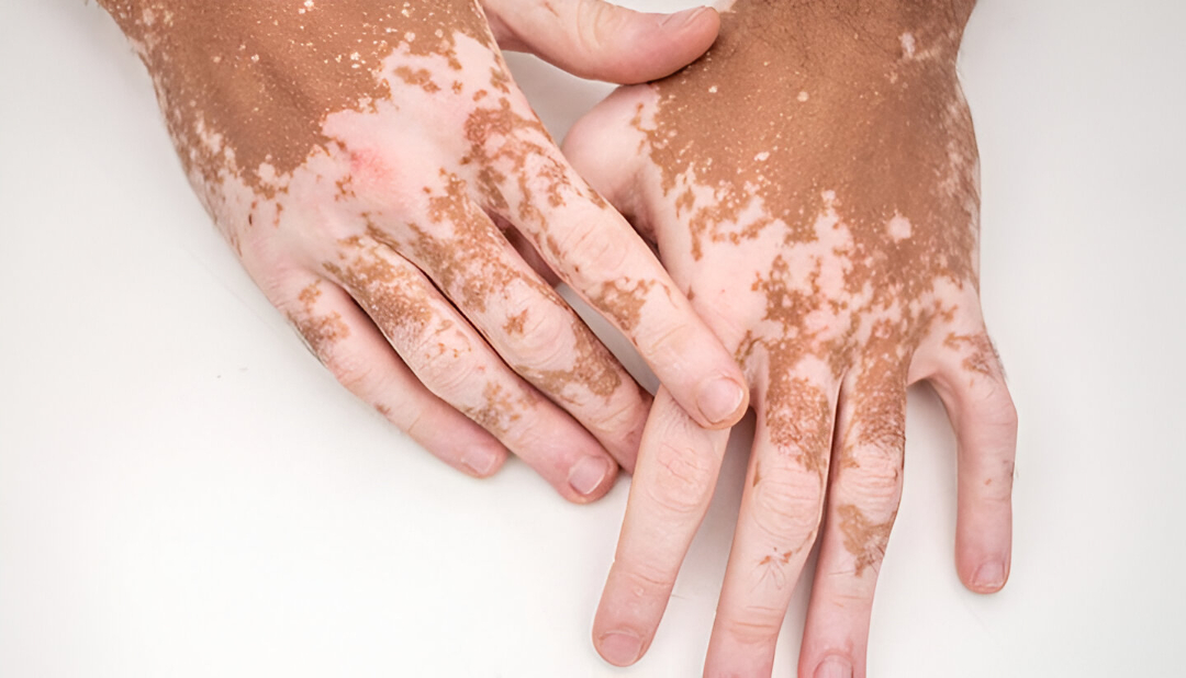 Vitiligo
