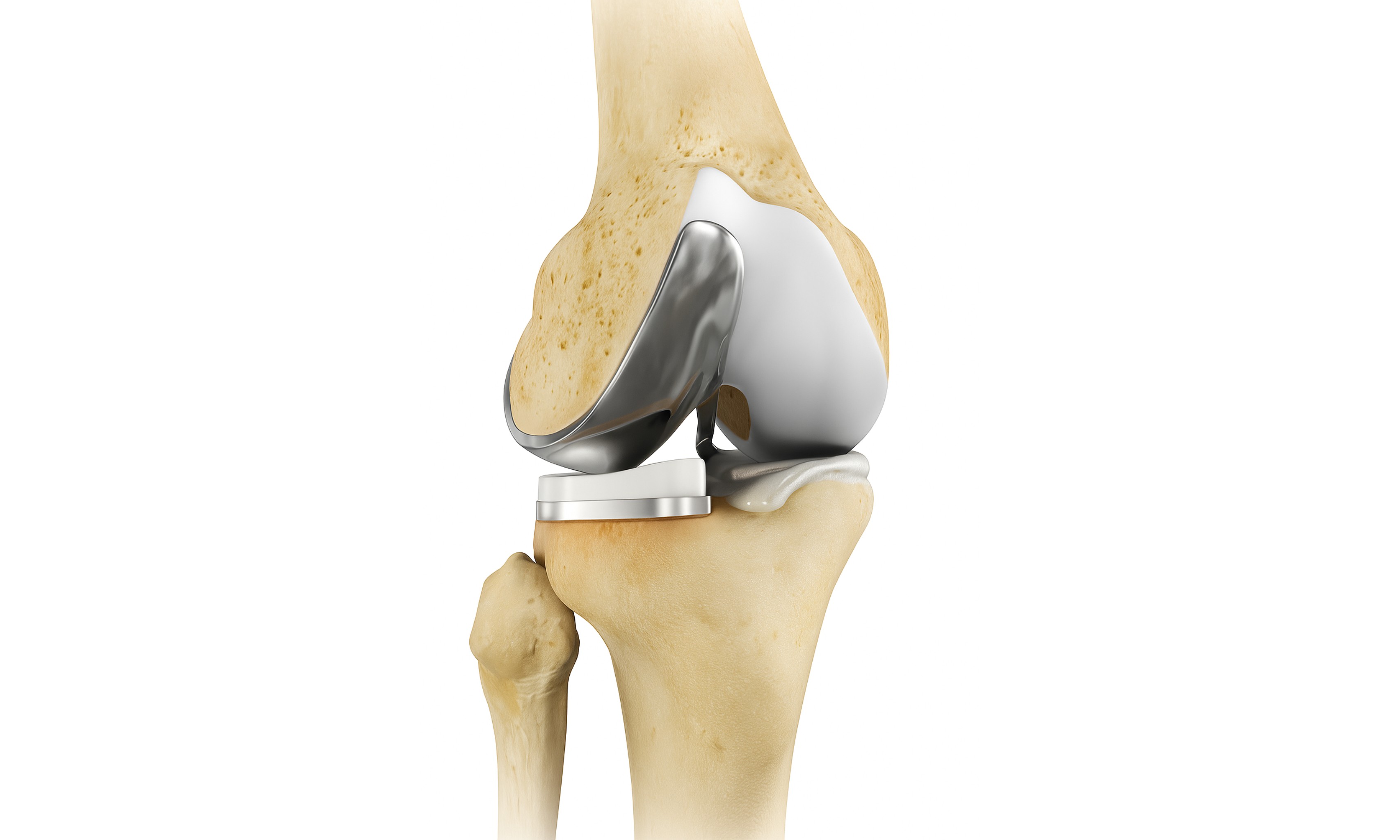 Partial_knee_Replacement