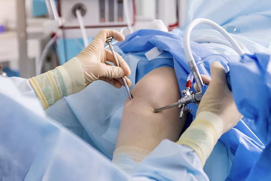 Shoulder_Arthroscopic_Surgeries